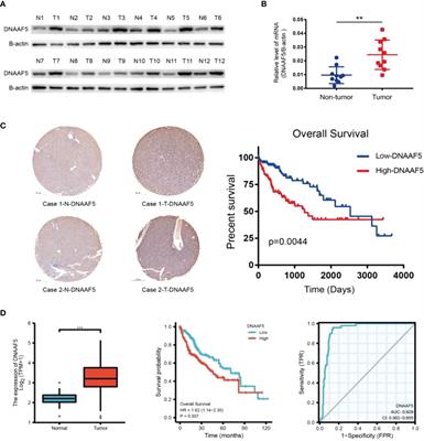 DNAAF5 promotes hepatocellular carcinoma malignant progression by recruiting USP39 to improve PFKL protein stability